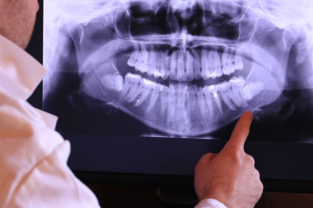Best Emergency Wisdom Teeth Removal in Clinton, PA